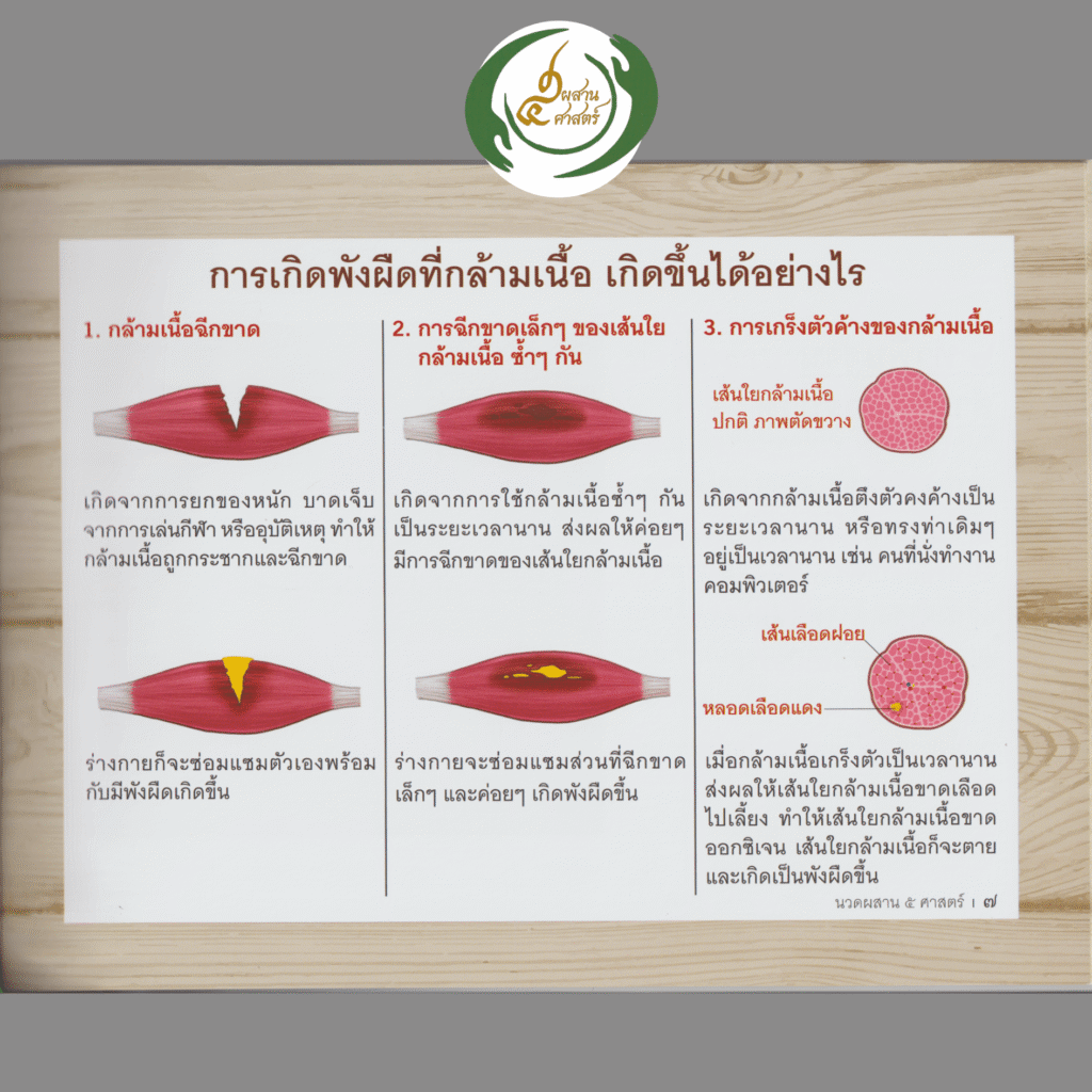 สาเหตุการเกิดพังผืดที่กล้ามเนื้อ